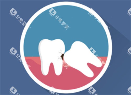 牙齿拥挤示意图