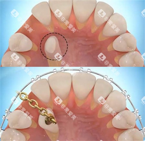 单颗牙齿牵引
