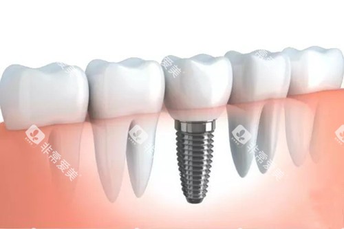 种植牙卡通图片