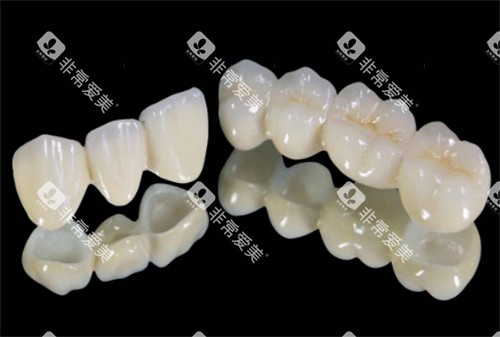 连冠的全瓷牙