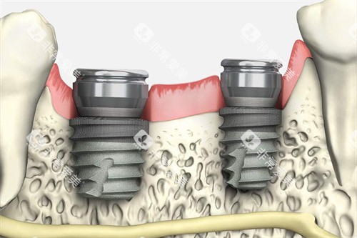 韩国多普勒种植牙植入模拟图