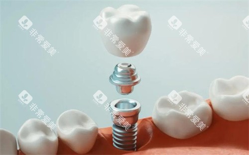 种植牙展示图片