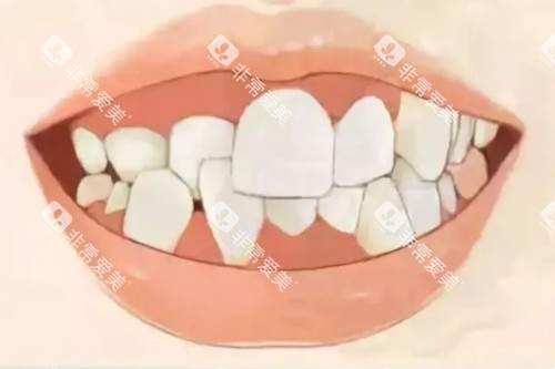 牙齿畸形卡通模型图