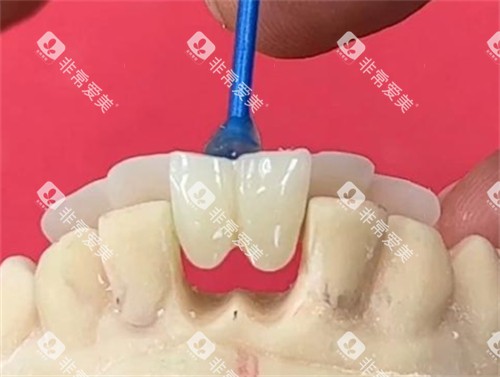 马里兰桥修复原理