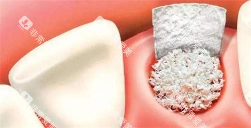 牙科骨粉示意图