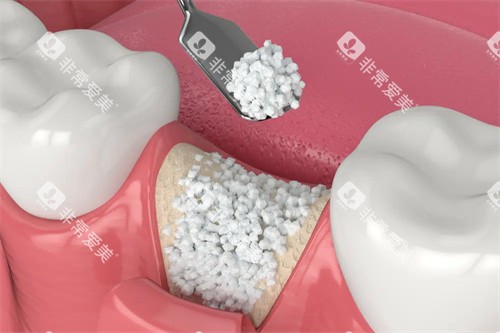 牙槽骨骨粉植入漫画图