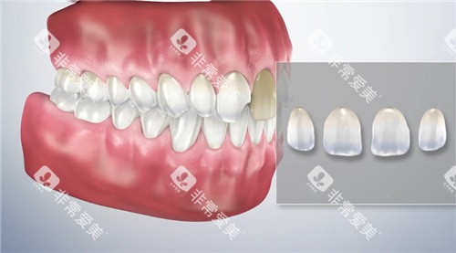 牙齿贴面预想图