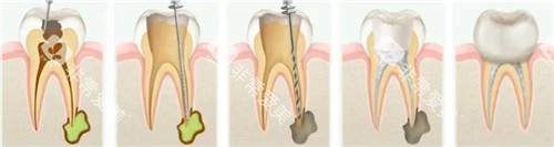 根管治疗步骤图