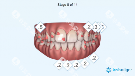 隐适美病例设计