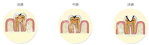 浅龋中龋深龋示意图 浅龋中龋深龋示意图