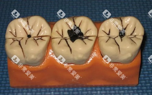 龋齿模型图 龋齿模型图