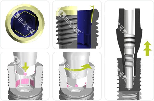 瑞士百丹特种植牙内部连接件 瑞士百丹特种植牙内部连接件