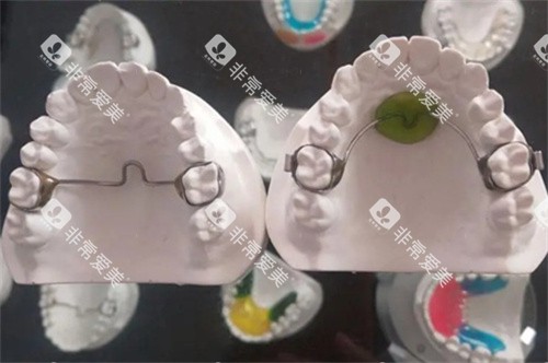 nance弓和横腭杆模型对比图 nance弓和横腭杆模型对比图