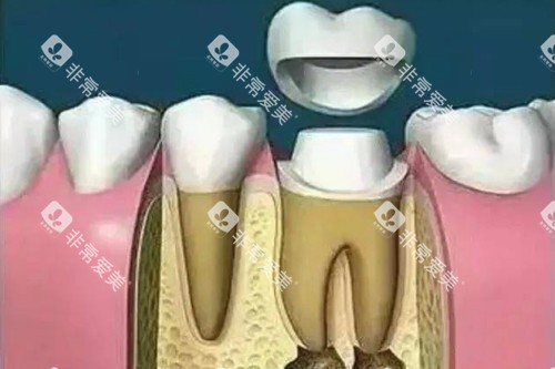 根管治疗戴牙冠卡通图