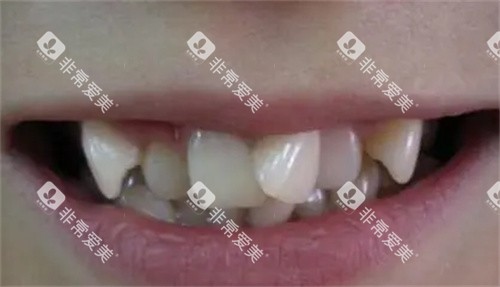 牙齿拥挤的照片
