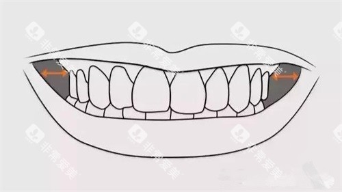 牙齿矫正扩牙弓颊廊