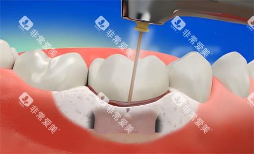 牙周炎激光治疗