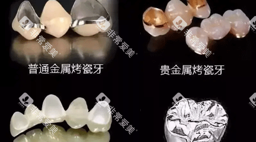 不同材质的牙冠照片
