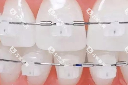 陶瓷半隐形矫正模型图