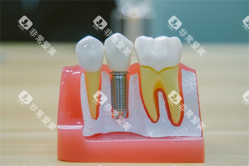 牙科种植牙模型 牙科种植牙模型