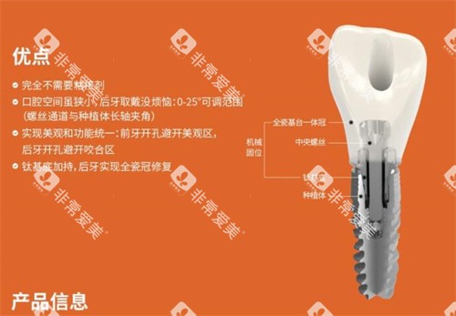 百齿泰植体优势有哪些