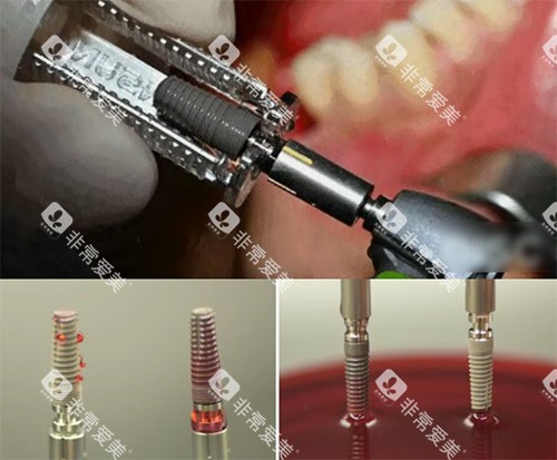 康盛种植牙照片