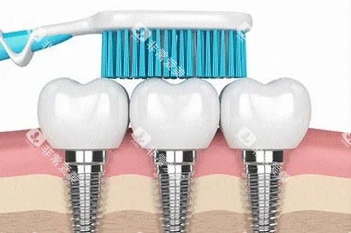 种植牙清洁卡通宣传图 种植牙清洁卡通宣传图