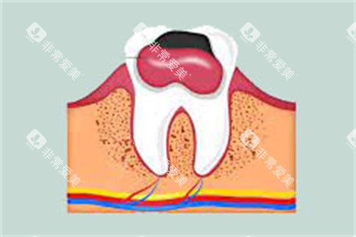 牙齿内息肉 牙齿内息肉