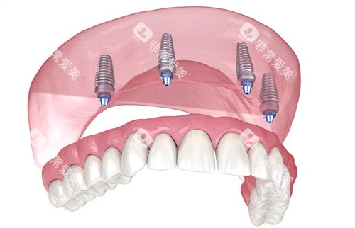 种植牙动画示意图片