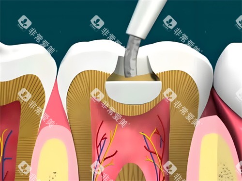 树脂补牙动画展示 树脂补牙动画展示