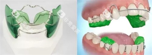 MRC如何佩戴 MRC如何佩戴