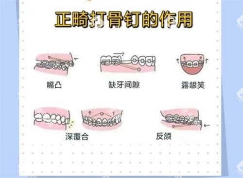 正畸打骨钉的作用