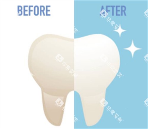 牙齿美白对比 牙齿美白对比