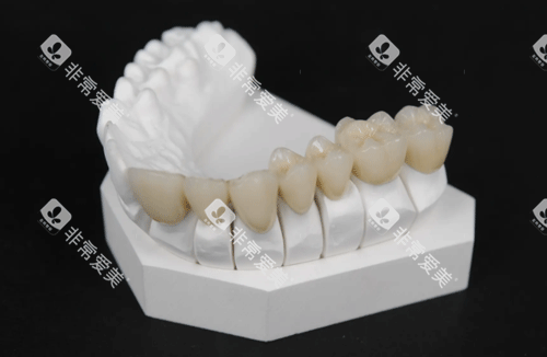 牙冠修复图 牙冠修复图