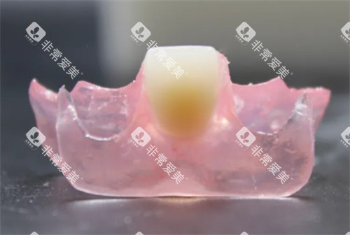 单颗牙冠 单颗牙冠