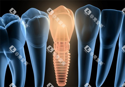 单颗种植牙动画图 单颗种植牙动画图