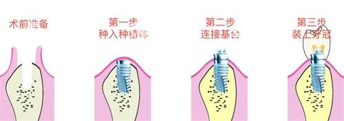 种植牙的步骤