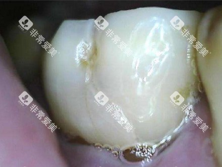 牙周炎症照片 牙周炎症照片