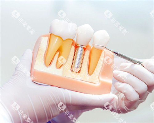 单颗种植牙模型 单颗种植牙模型