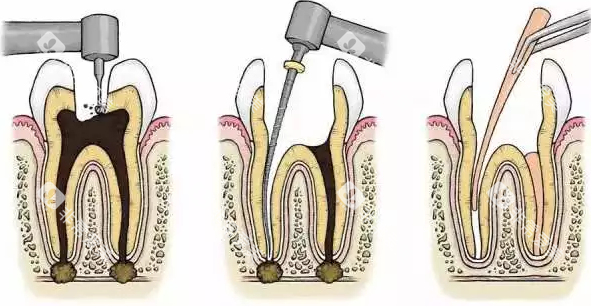 根管治疗过程 根管治疗过程