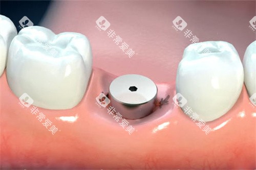 单颗种植牙愈合基台卡通图 单颗种植牙愈合基台卡通图