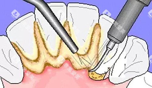 牙结石超声波洁牙示意图 牙结石超声波洁牙示意图