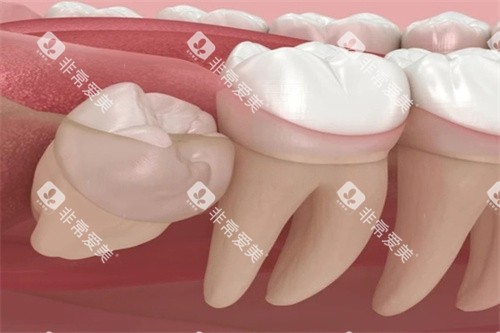 智齿朝外长 智齿朝外长