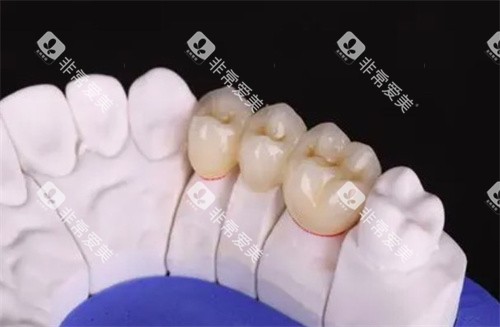 爱尔创全瓷牙