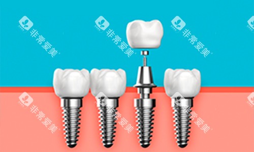 种植牙展示图 种植牙展示图