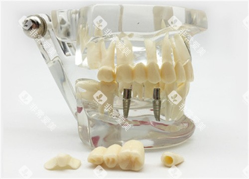 种植牙模具