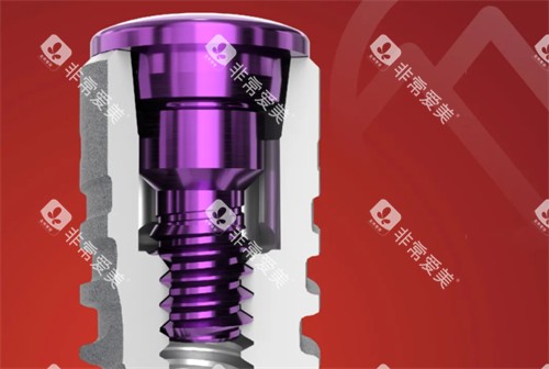 卡尔斯种植牙简介