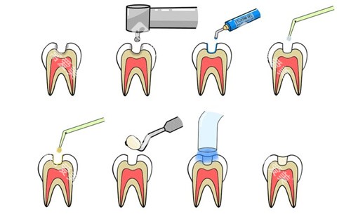补牙步骤 补牙步骤