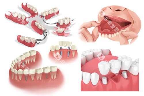 牙齿修复的几种方式 牙齿修复的几种方式