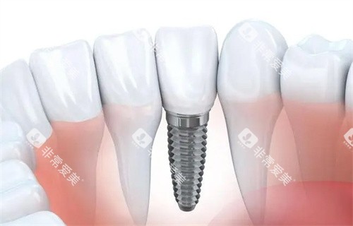 种植牙的样子 种植牙的样子